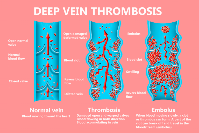 Tromboembolismo Venoso