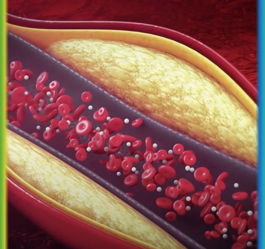O impacto silencioso do colesterol no coração